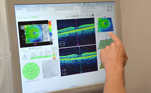 Optical Coherence Tomography